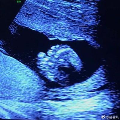 怀孕两个月做了b超会辐射胎儿吗（怀孕两个月做b超看得出来吗）