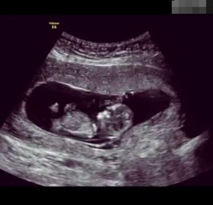 怀孕两个月做了b超会辐射胎儿吗（怀孕两个月做b超看得出来吗）