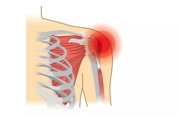 侧平举时肩关节痛是怎么回事（做侧平举的时候肩膀里的筋疼）